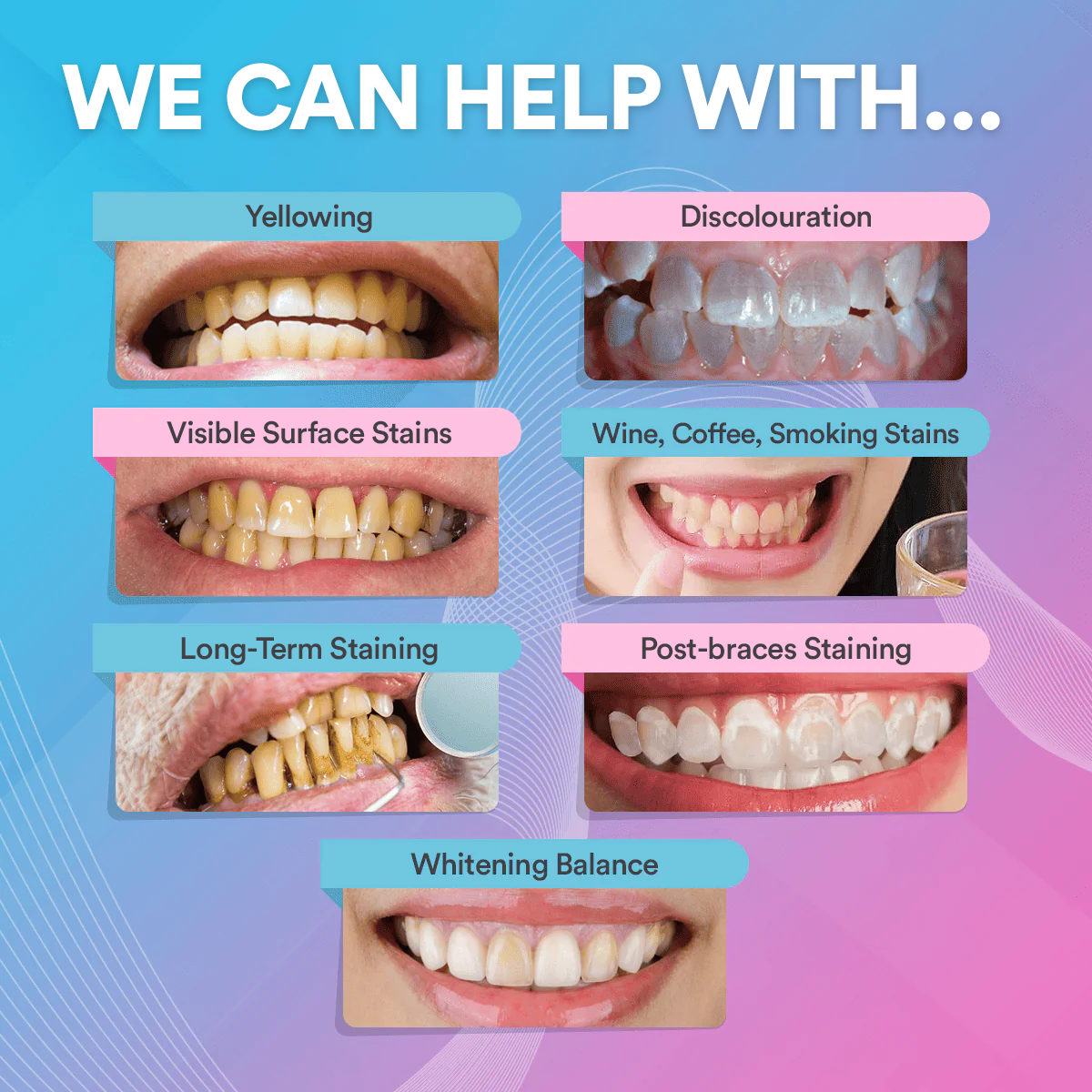 Teeth Whitening Strips (14 Treatments) DP4