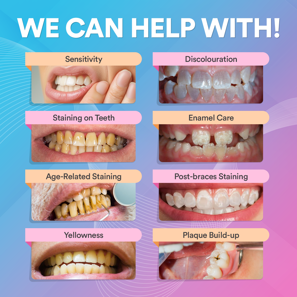 Advanced Teeth Whitening Kit PAP+